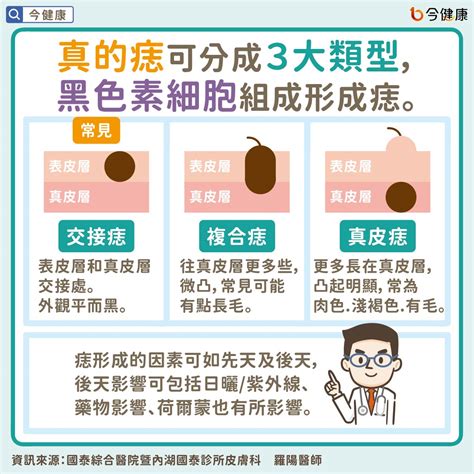 為什麼會長黑痣|是痣？皮膚癌？還是什麼？常見Q&A解惑！醫教揪出「。